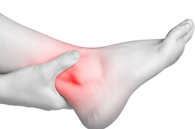 Inflammation of the joints with gout